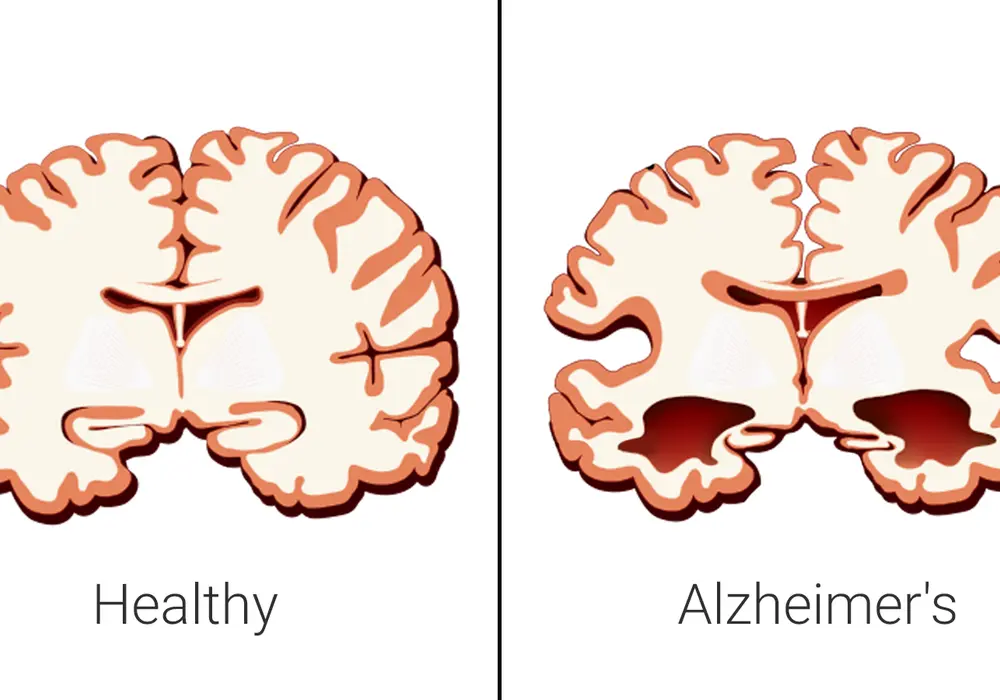 Alzheimer - Co naprawdę zabija? Powikłania, opieka paliatywna
