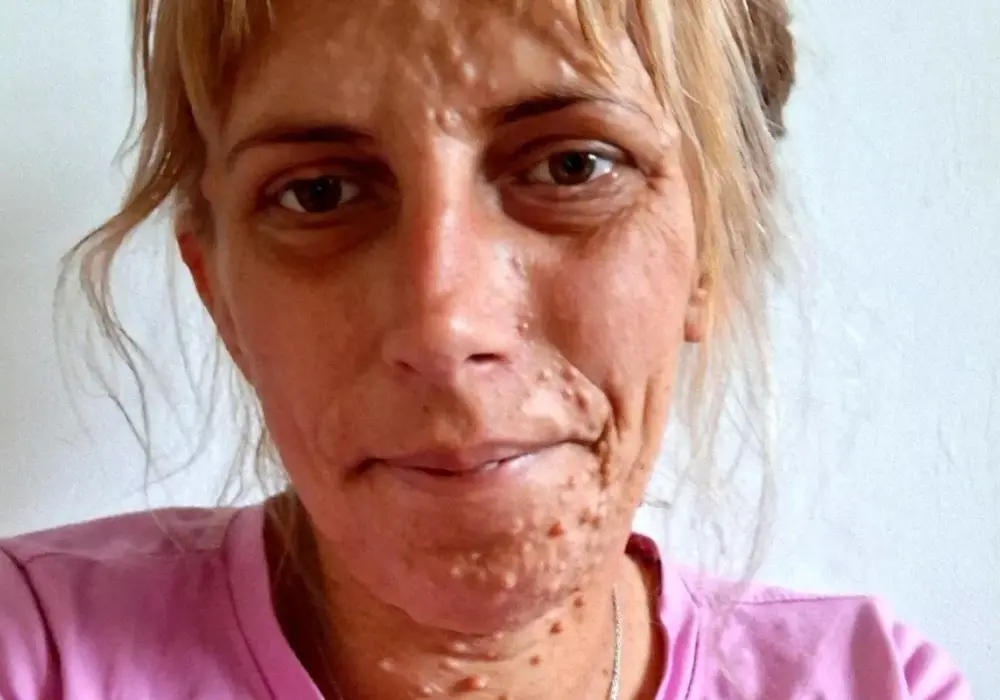 Neurofibromatoza typu 1 (NF1) - Objawy, leczenie, życie z chorobą
