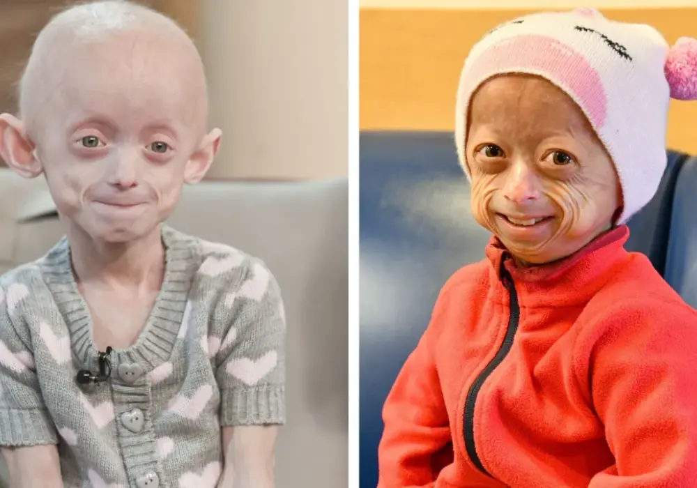 Progeria - Jak zrozumieć i wspierać dziecko z rzadką chorobą?