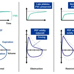 Wykresy spirometrii pokazują normalną, obturacyjną i restrykcyjną krzywą przepływ-objętość, ilustrując FVC i PEF.