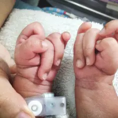 Dwa maleńkie, noworodkowe dłonie, jedna z opaską, symbolizują nadzieję i walkę z zespołem Edwardsa.