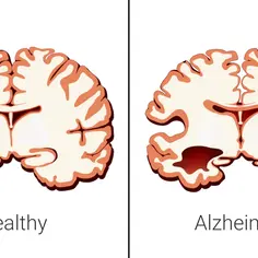Porównanie mózgu zdrowego i chorego na Alzheimera. U chorych widoczne są zaniki tkanki mózgowej, co pokazuje, na co umierają chorzy na alzheimera.