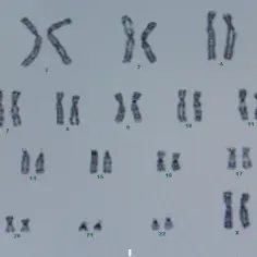 Ile chromosomów ma człowiek z autyzmem? Zaskakujące fakty genetyczne