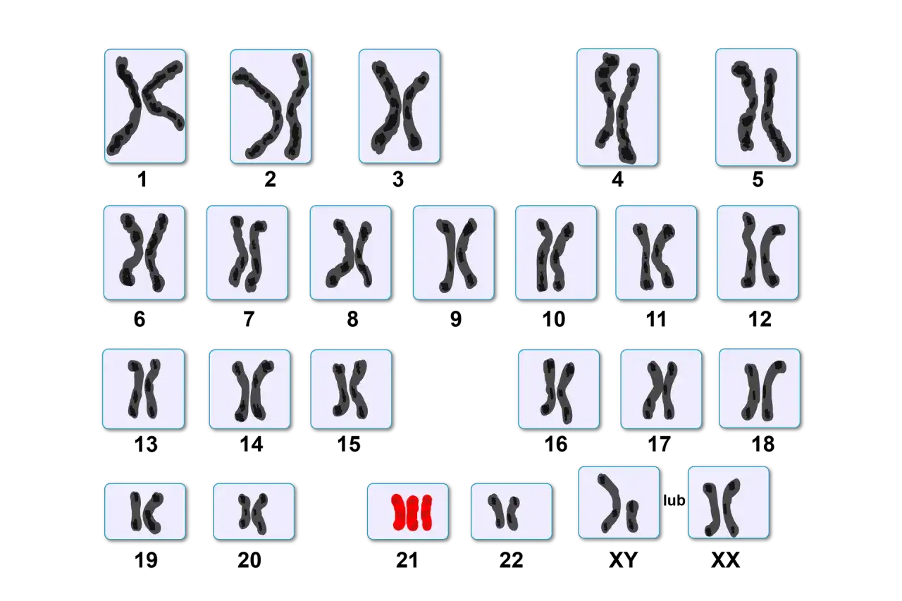 Kariotyp człowieka z trisomią chromosomu 21, która jest przyczyną zespołu Downa. Widoczne pary chromosomów, a na dole trzy chromosomy 21.
