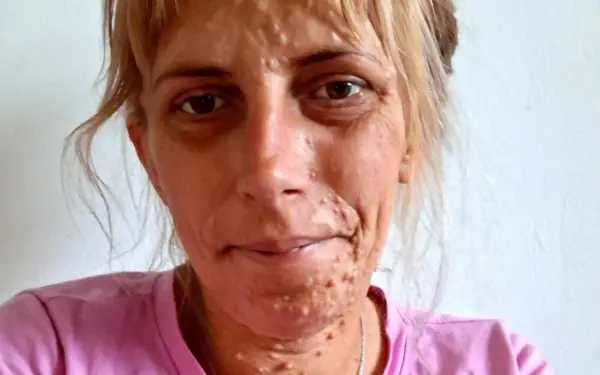 Neurofibromatoza typu 1 (NF1) - Objawy, leczenie, życie z chorobą