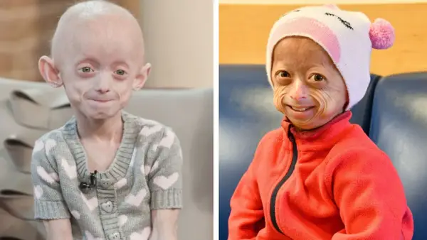 Progeria - Jak zrozumieć i wspierać dziecko z rzadką chorobą?